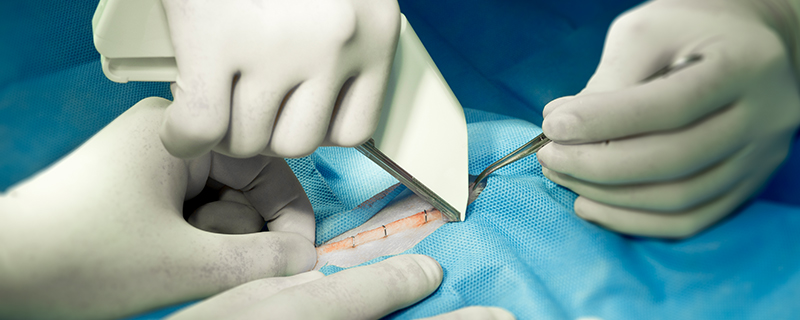 surgical stapler in surgery